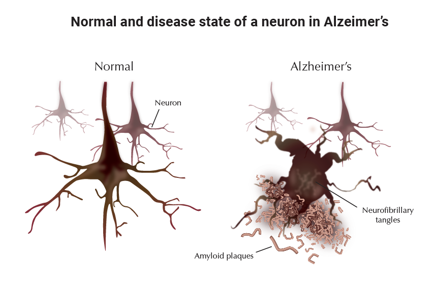 Normal and disease state of a neuron in Alzeimer's